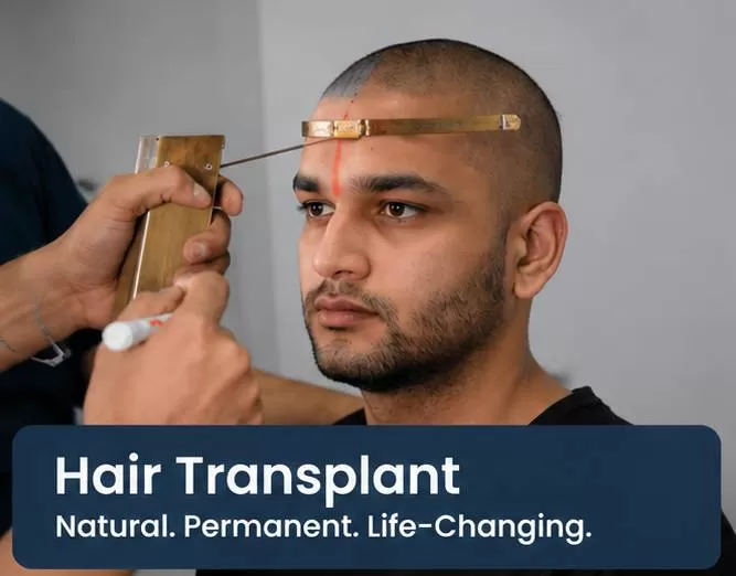 Hair Transplant